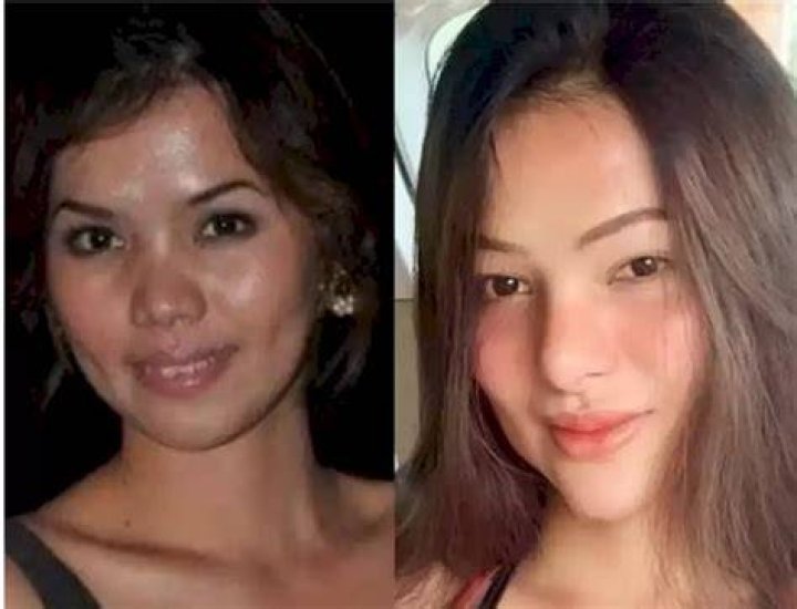 Sunshine Guimary Before And After Plastic Surgery